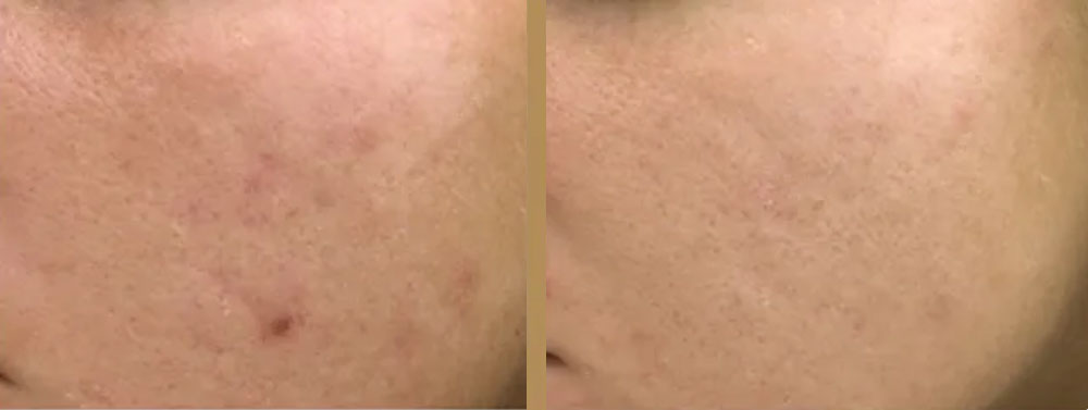 before and after skin tightening toronto