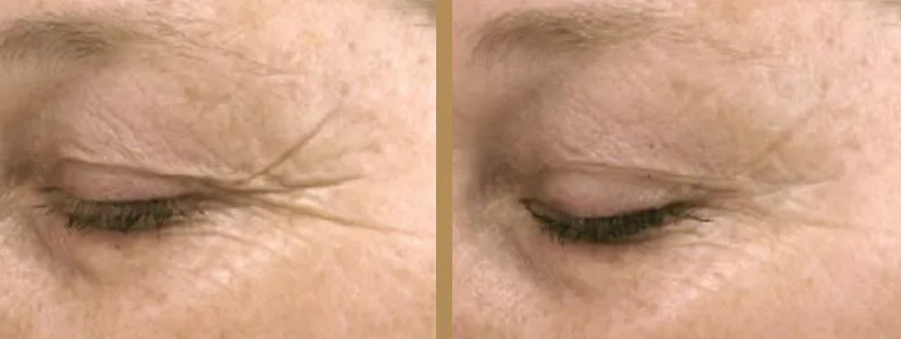before and after wrinkle smoothing toronto