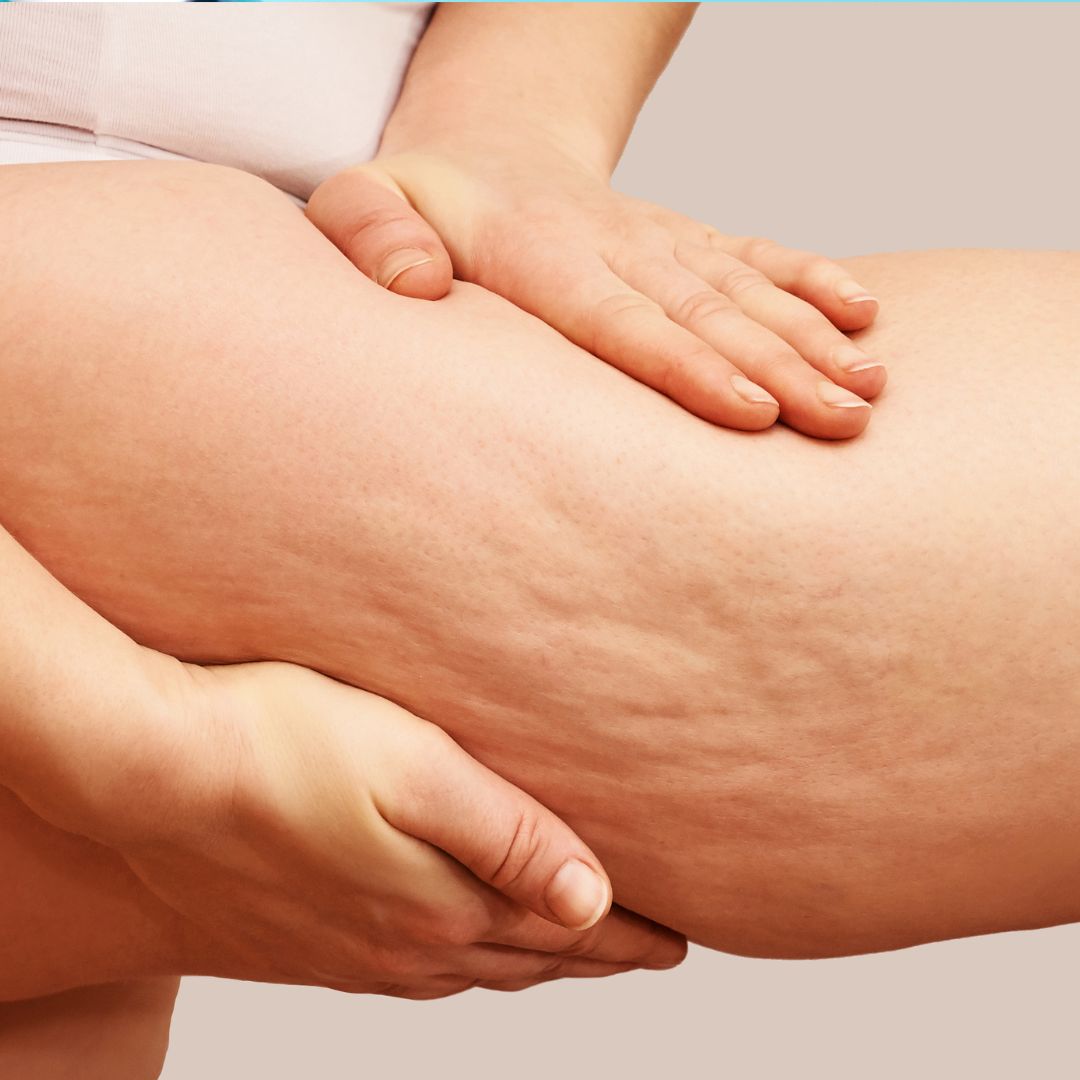 woman showing cellulite