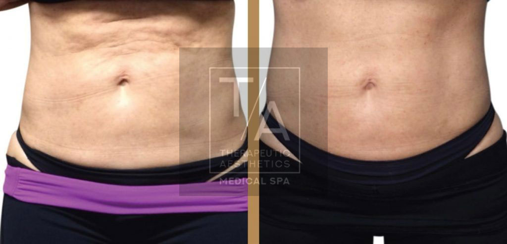 before and after fat removal toronto