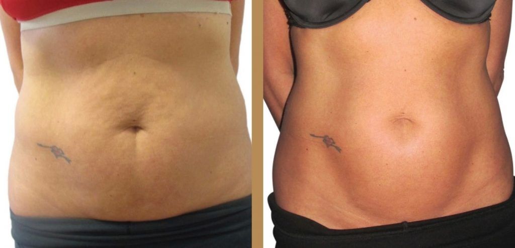 before and after fat removal toronto
