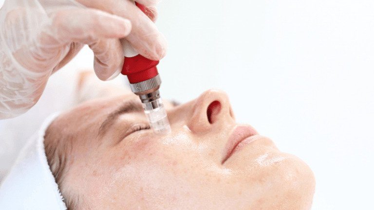 Why do you need microneedling treatment now?