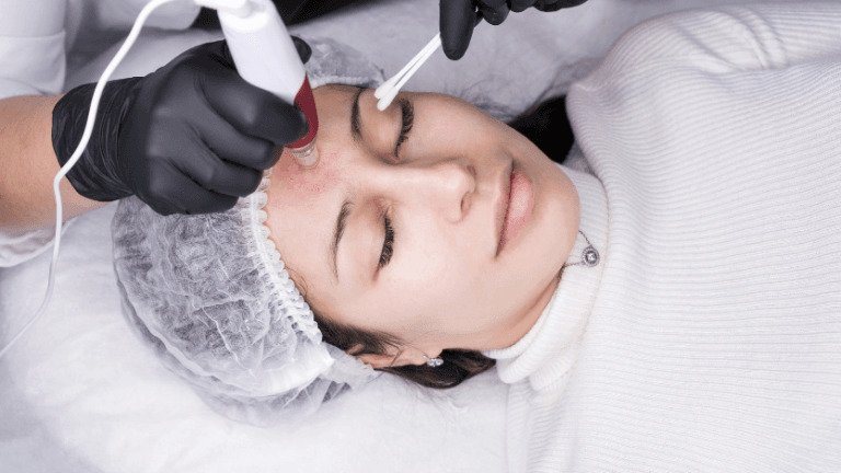 Woman having Microneedling treatment