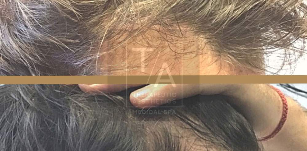 before and after prp hair restoration toronto