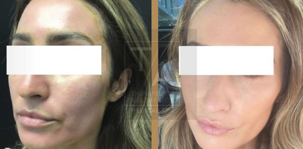 before and after prp skin restoration toronto
