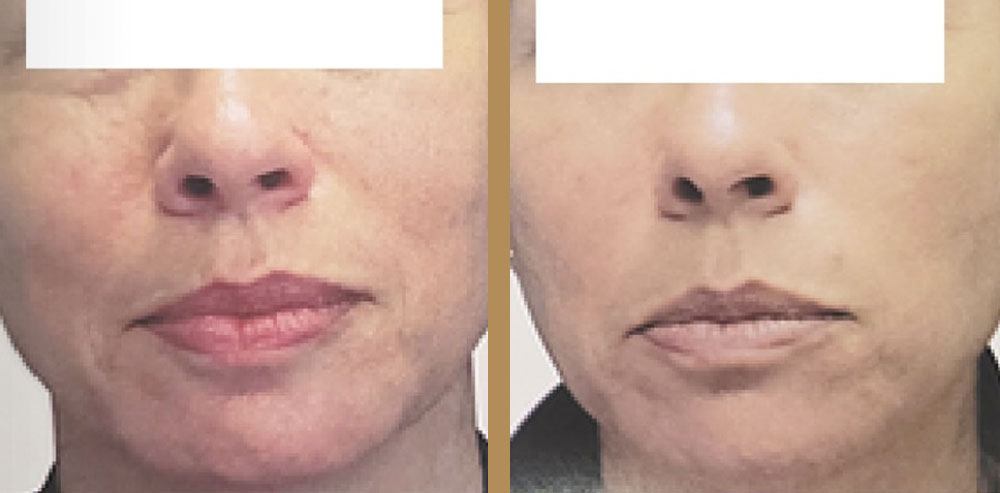 before and after wrinkle treatment toronto