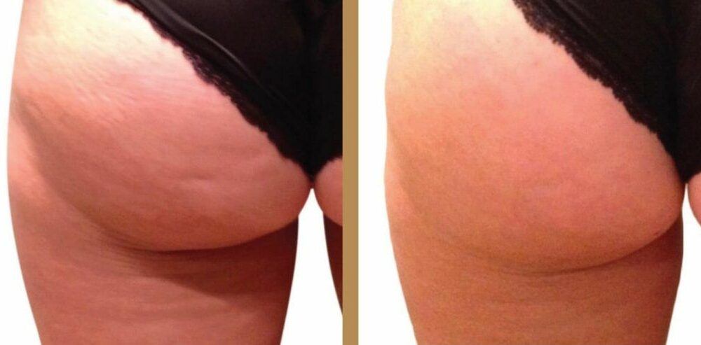body slimming before and after results