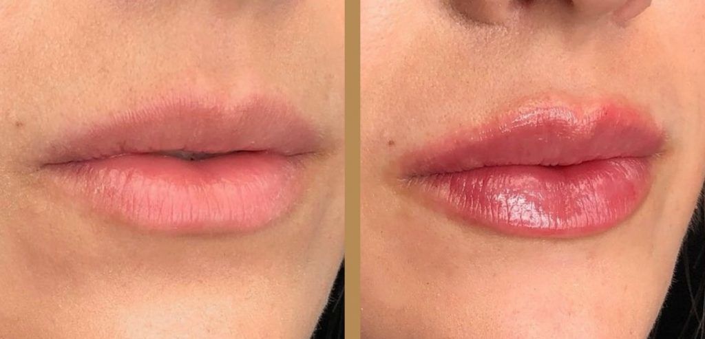 lip filler results