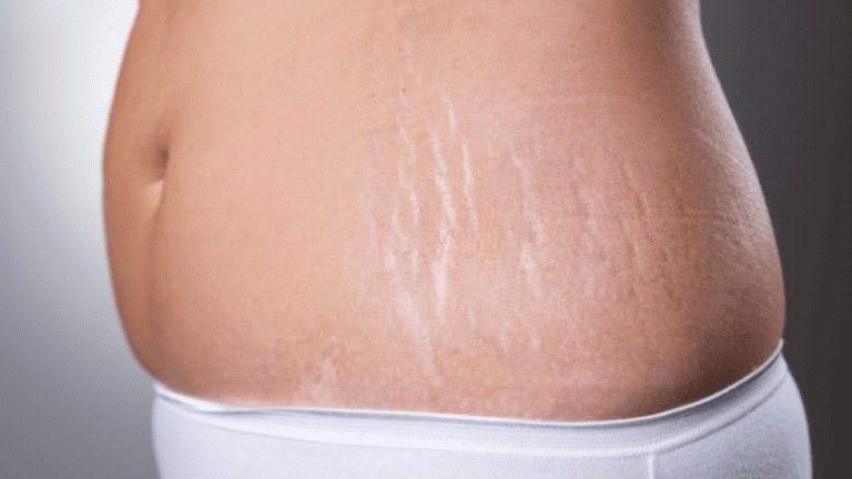 How does microneedling help in getting rid of stretch marks?