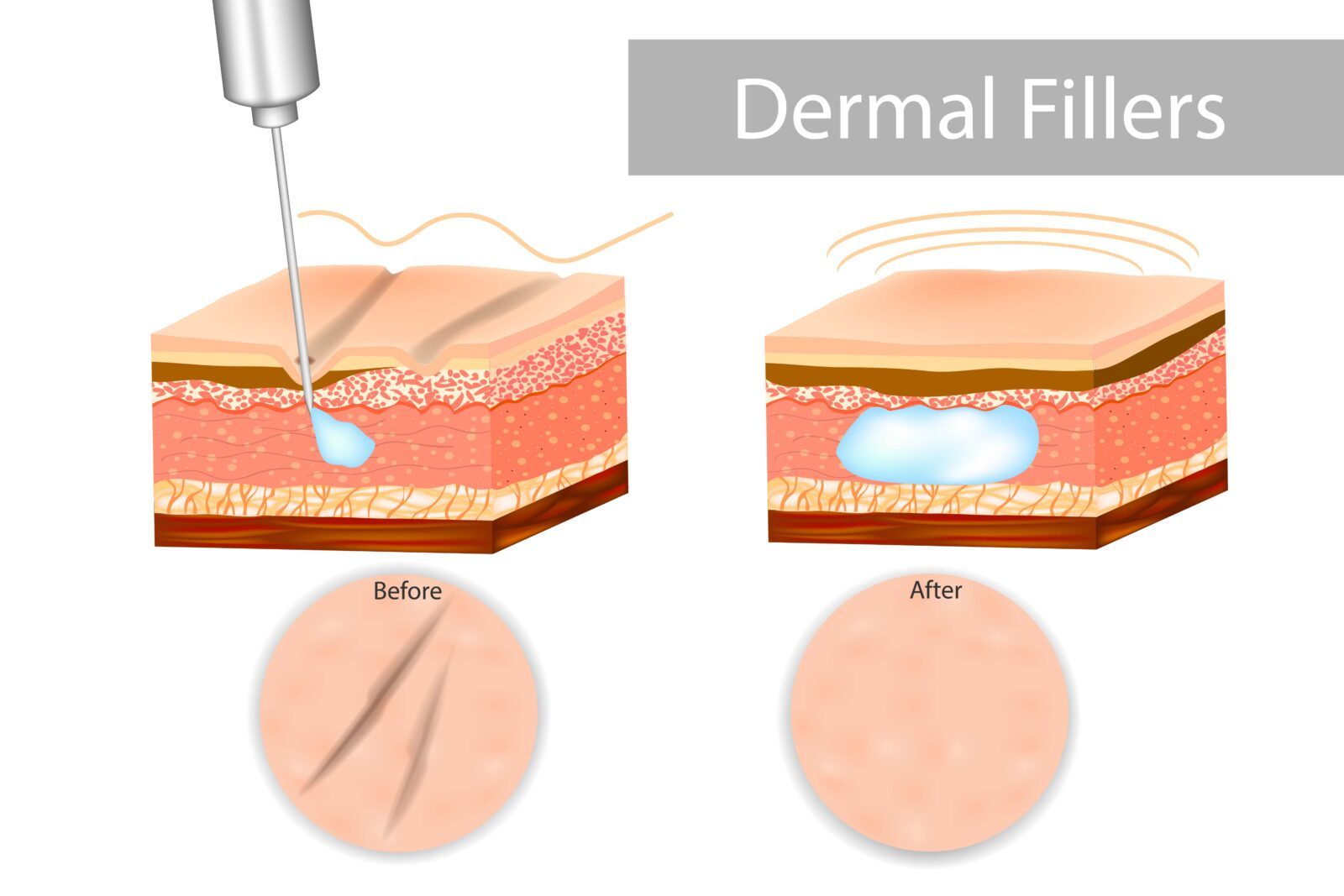 diagram showing how dermal fillers work