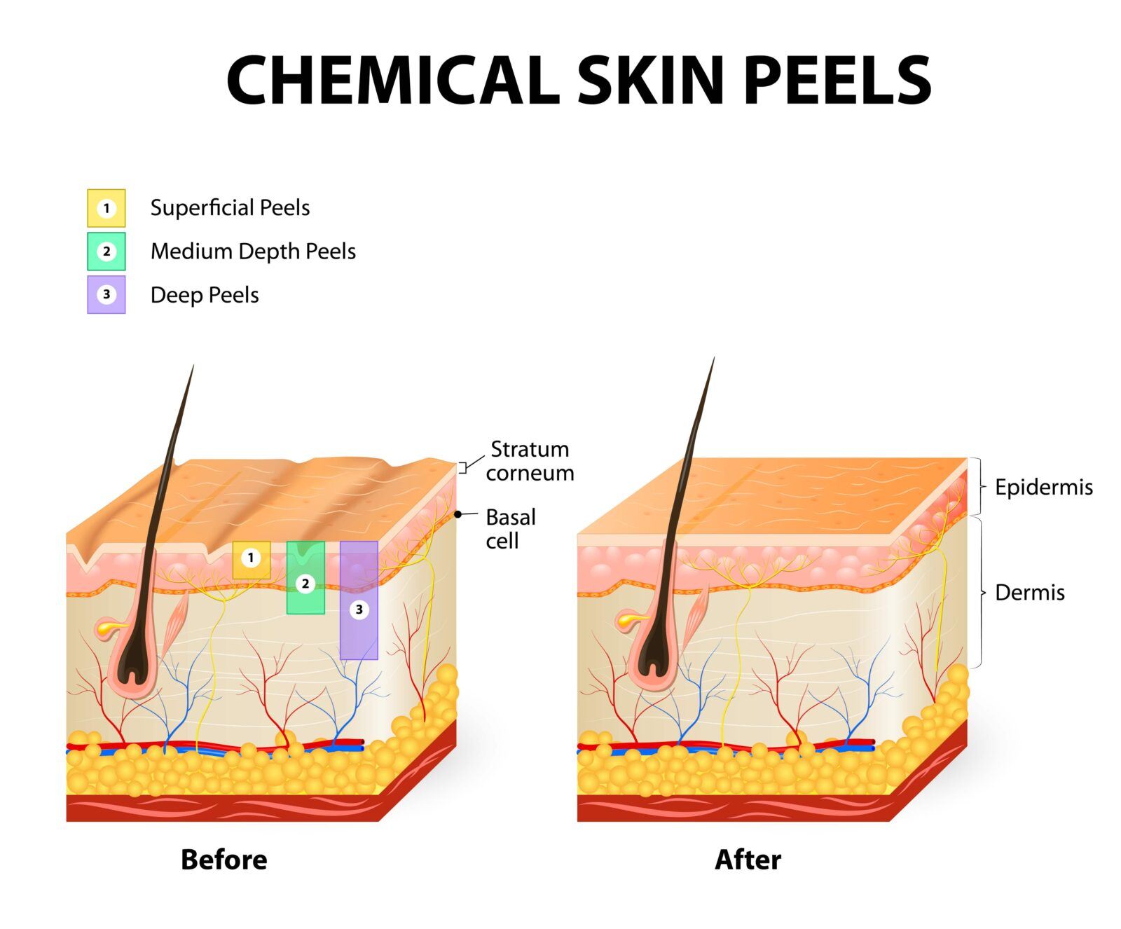 how different chemical peels affect the skin
