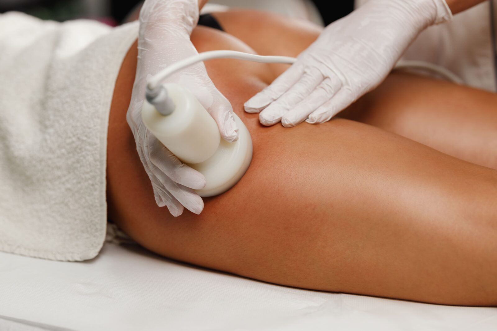 radiofrequency cellulite treatment