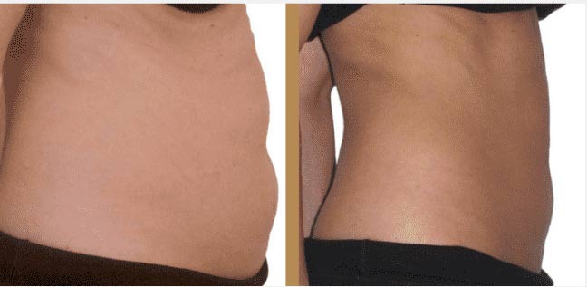 before and after body contouring treatment