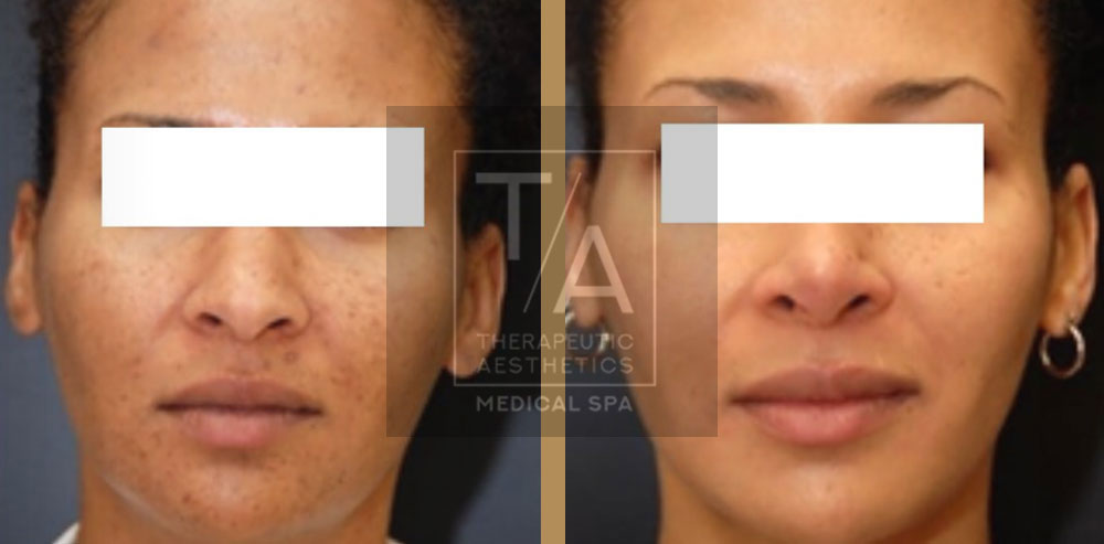 before and after chemical peel Toronto