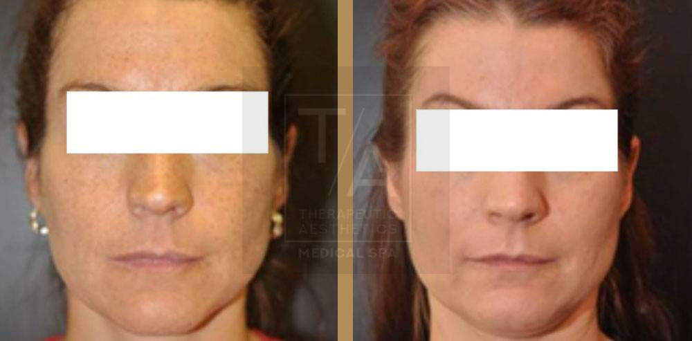 before and after chemical peel Toronto