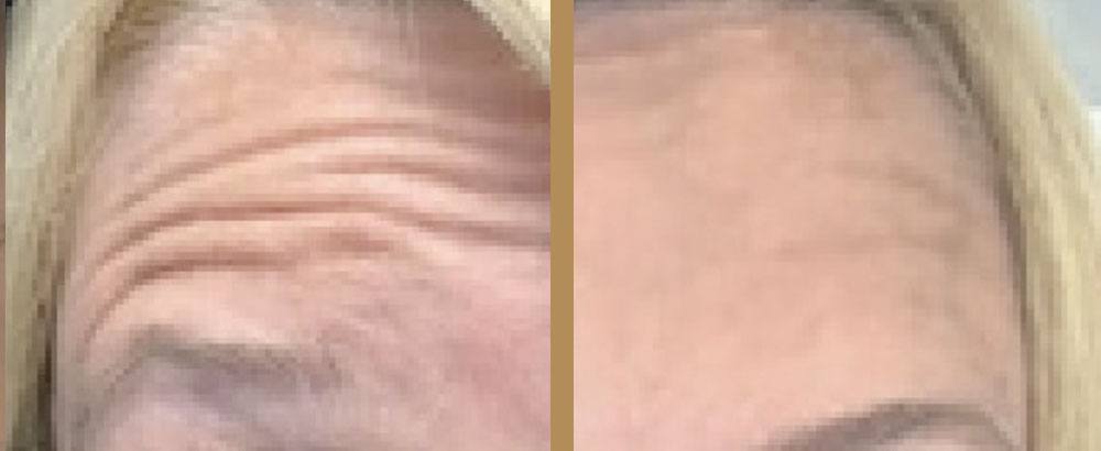 before and after botox treatment toronto