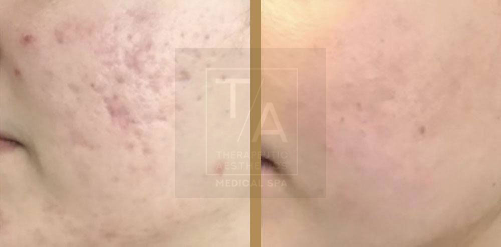 before and after prp treatment toronto